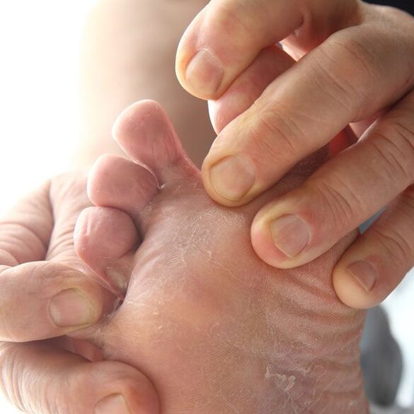 Ciuperca afectează pielea dintre degetele de la picioare