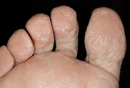 Manifestări ale unei infecții fungice pe picioare
