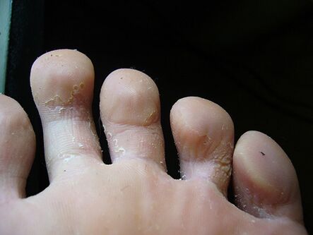 Peelingul și descuamarea pielii de pe picioare este un semn de ciupercă