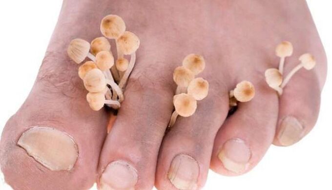 ciuperca dintre degetele de la picioare