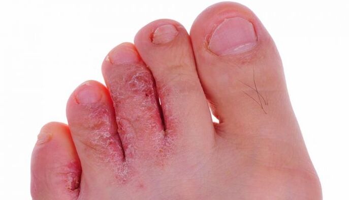 infecție fungică a pielii degetelor de la picioare