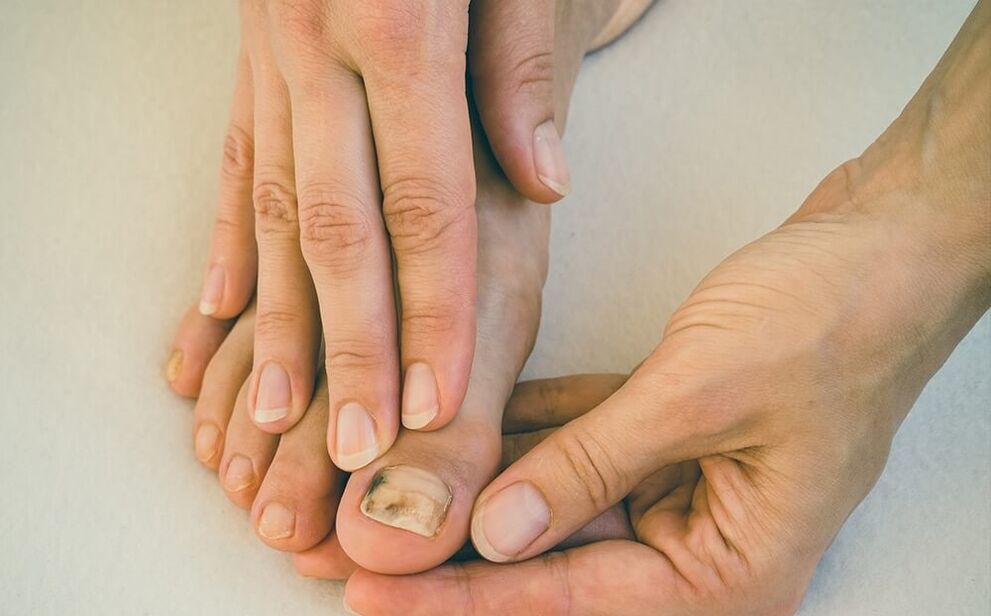 ciuperca unghiilor de la picioare cum se trateazã