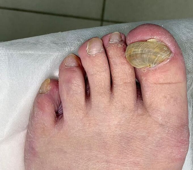 Onicomicoză hipertrofică pe picior - unghie deformată