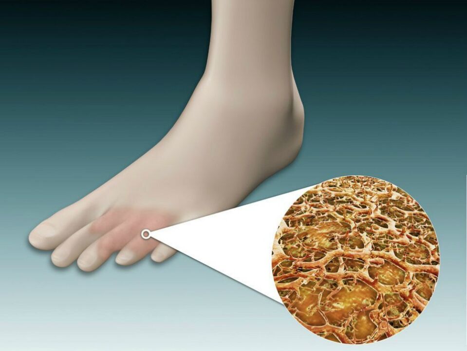 Roșeață a pielii între și în apropierea degetelor de la picioare cu ciupercă intertriginoasă