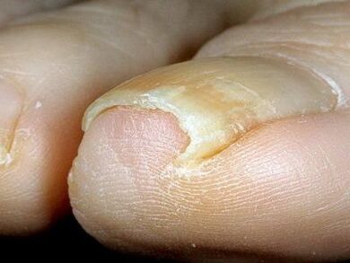 Apariția unghiilor de la picioare infectate cu ciuperci